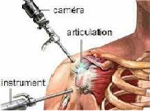 chirurgie-de-la-coiffe-des-rotateurs-2